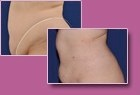 Body-Jet Case Study