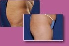 Body-Jet Case Study